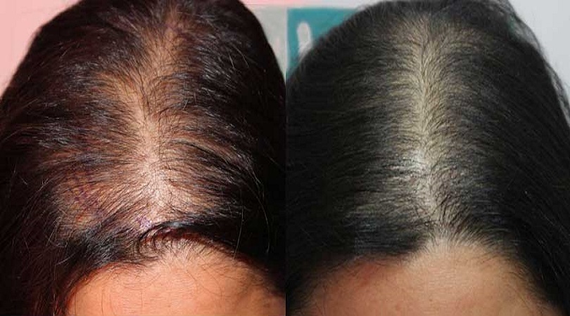 Female Pattern Hair Loss