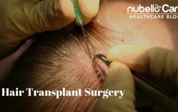 Hair Transplant Surgery and Its Procedure
