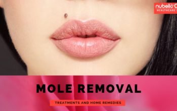 Mole Removal Treatments and Home Remedies