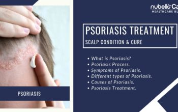 Psoriasis Treatment: Skin Condition and Cure!