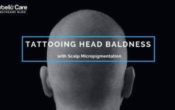 Tattooing Head Baldness with Scalp Micropigmentation