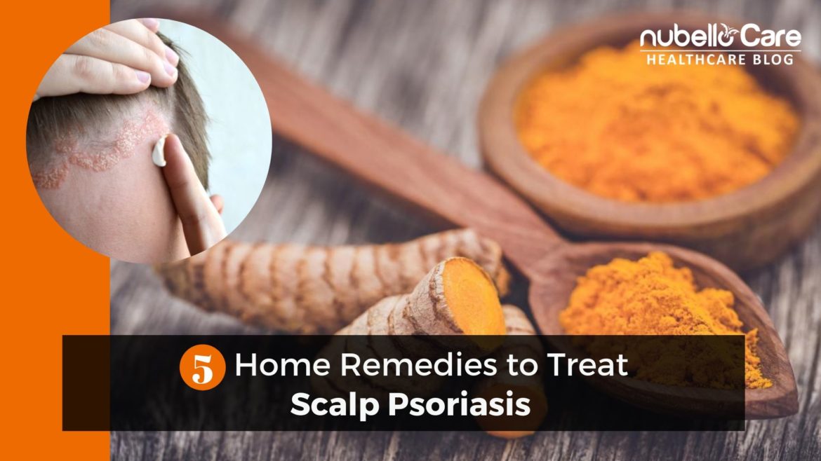 5 Home Remedies to Treat Scalp Psoriasis