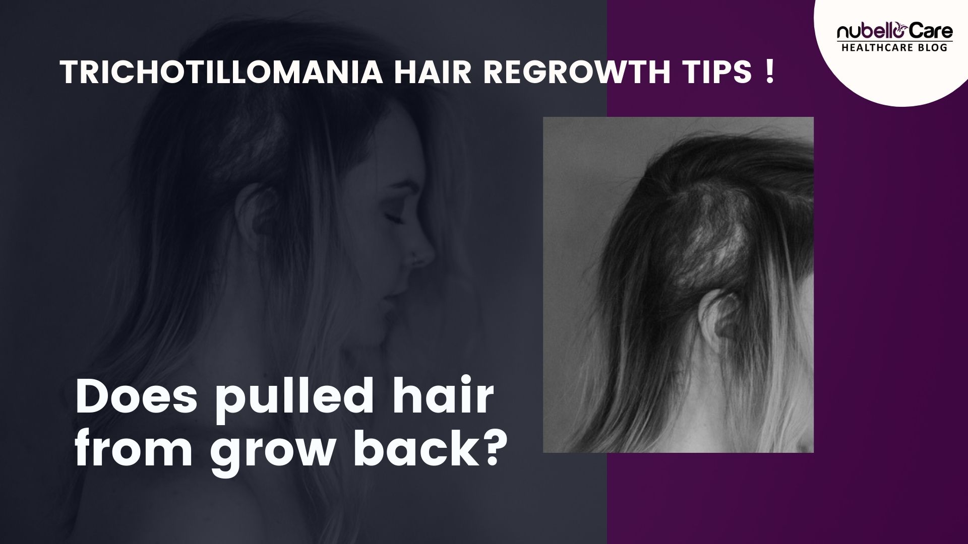 Does pulled hair from grow back? Trichotillomania Hair Regrowth Tips