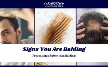 5 Signs You Are Balding! How Do You Stop It?