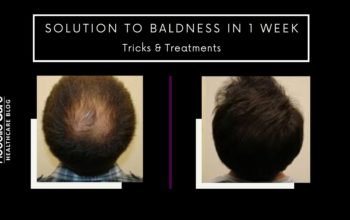 Solution to Baldness in 1 Week. Tricks and Treatments.